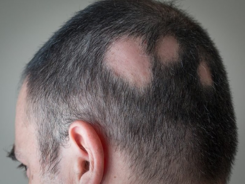 هر آنچه درباره ریزش موی سکه ای باید بدانید