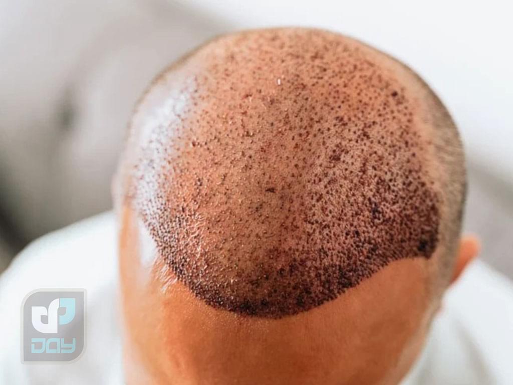 همه چیز درباره هزینه کاشت مو 4 هزینه کاشت مو چقدر است