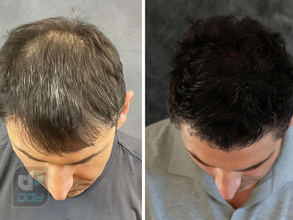 همه چیز درباره هزینه کاشت مو 3 هزینه کاشت مو_1