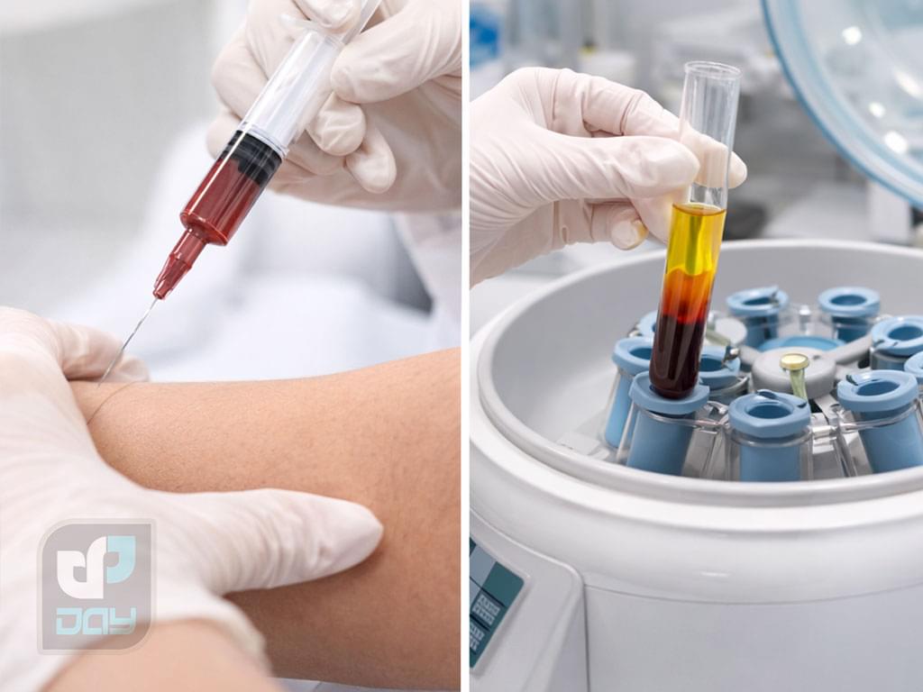 ترمیم مو به روش PRP؛ کاربردها، مزایا و میزان اثربخشی 2 ترمیم مو به روش prp-مراحل انجام