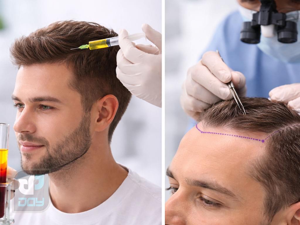 ترمیم مو به روش PRP؛ کاربردها، مزایا و میزان اثربخشی 4 ترمیم مو به روش PRP-4