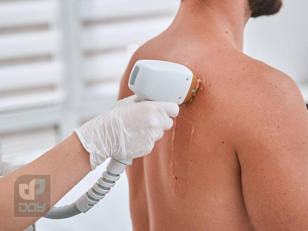لیزر موهای زائد در شیراز | قیمت، مزایا، مراقبتها 5 موهای زائد در شیراز 4