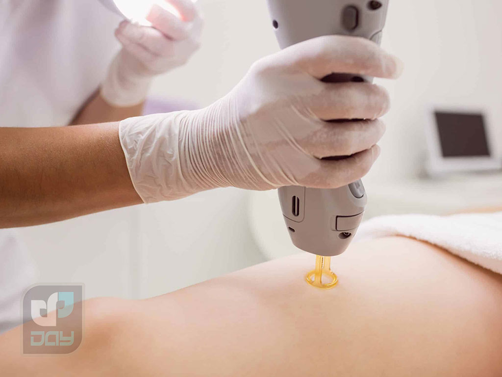 لیزر موهای زائد در شیراز | قیمت، مزایا، مراقبتها 6 لیزر موهای زائد در شیراز-5