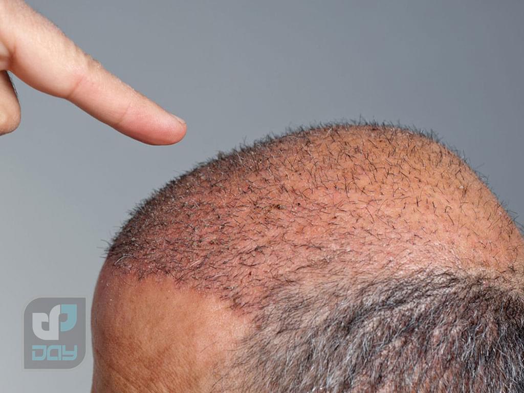 مراقبت های بعد از عمل کاشت مو: راهنمای کامل 2 مراقبت های بعد از عمل کاشت مو-1