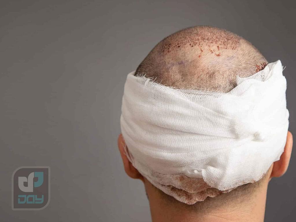 مراقبت های بعد از عمل کاشت مو: راهنمای کامل 3 مراقبت های بعد از عمل کاشت مو-2