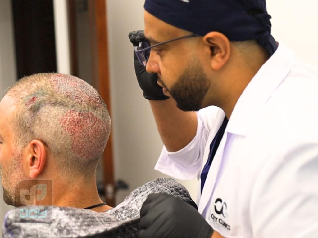 مراقبت های بعد از عمل کاشت مو: راهنمای کامل 4 مراقبت های بعد از عمل کاشت مو-3