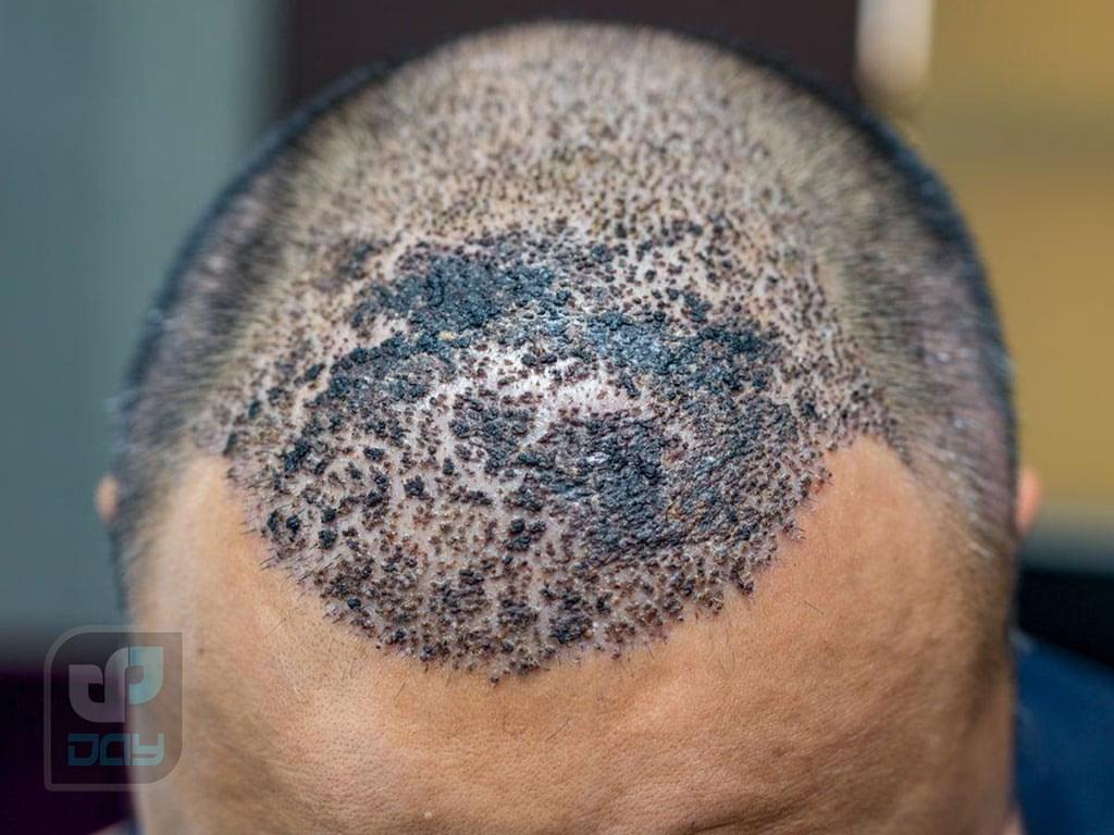 مراقبت های بعد از عمل کاشت مو: راهنمای کامل 6 مراقبت های بعد از عمل کاشت مو-6