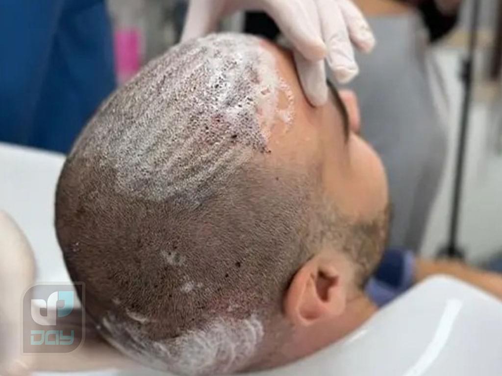 مراقبت های بعد از عمل کاشت مو: راهنمای کامل 8 مراقبت های بعد از عمل کاشت مو-7