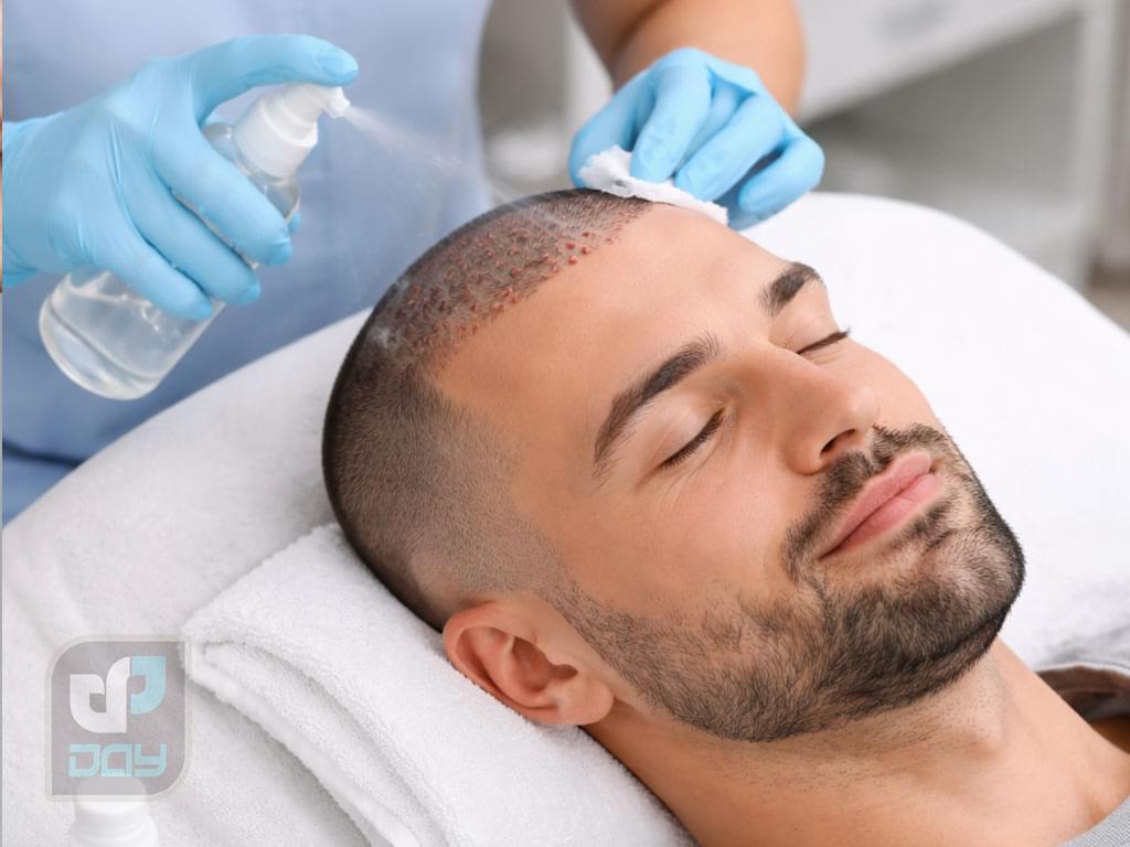 مراقبت های بعد از عمل کاشت مو: راهنمای کامل 1 مراقبت های بعد از عمل کاشت مو