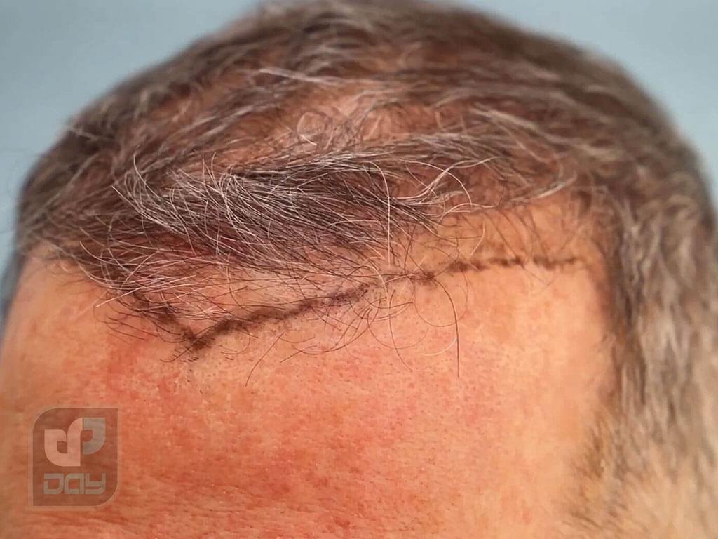 کاشت مو برای چه کسانی مناسب است؟ 4 کاشت مو برای چه کسانی مناسب است-2