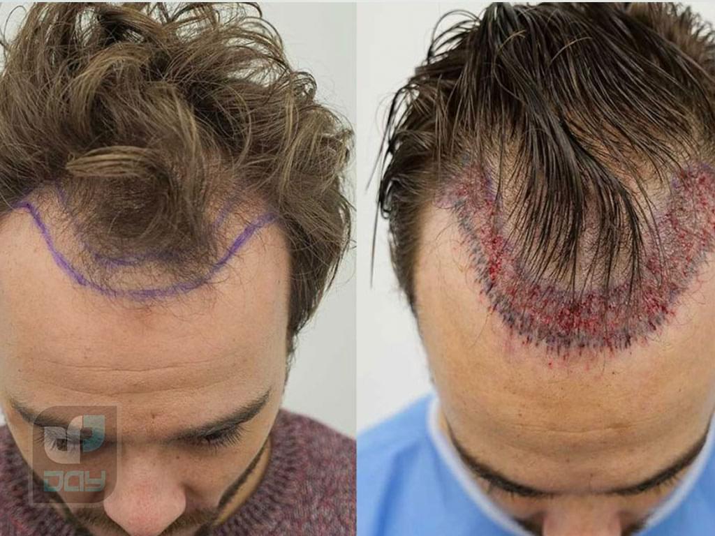 کاشت مو برای چه کسانی مناسب است؟ 6 کاشت مو برای چه کسانی مناسب است-4