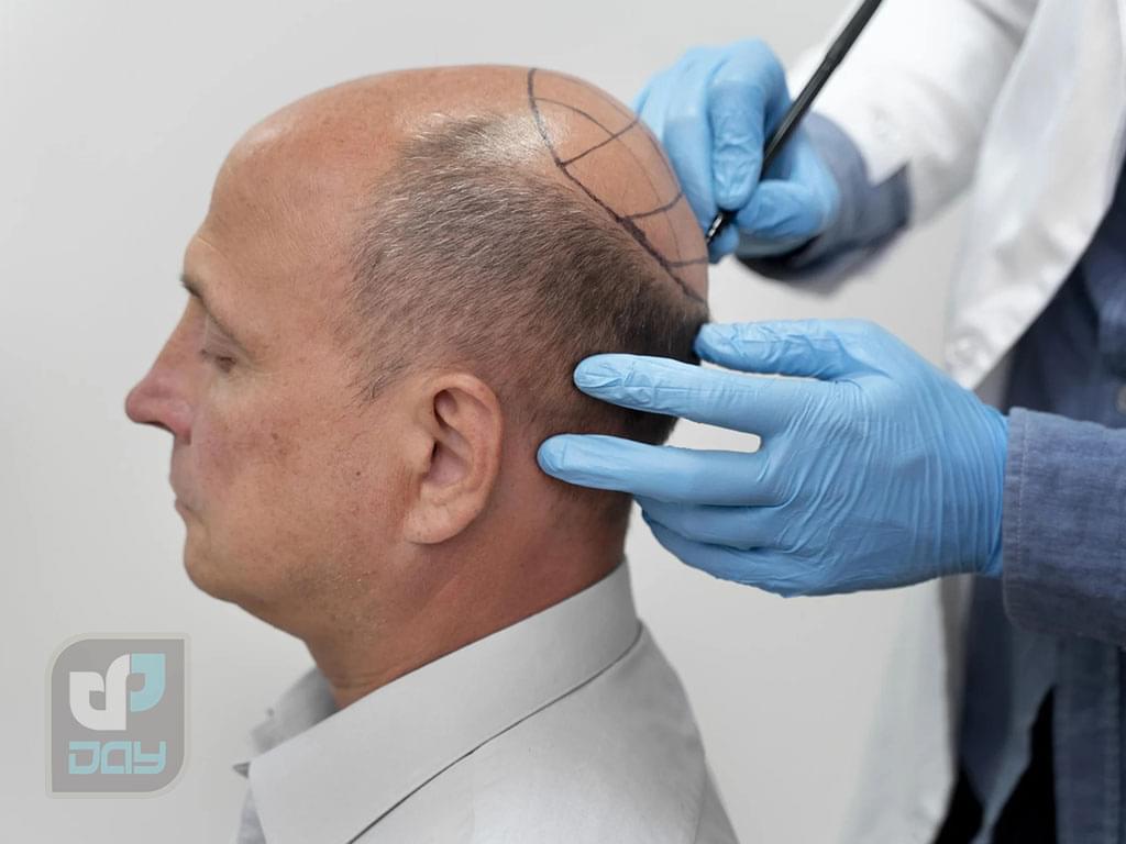 ۱۰ نکته مهم قبل از کاشت مو که باید بدانید 2 کاشت مو و ده نکته قبل از جراحی-2