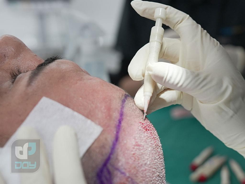 ۱۰ نکته مهم قبل از کاشت مو که باید بدانید 4 کاشت مو و ده نکته قبل از جراحی-4