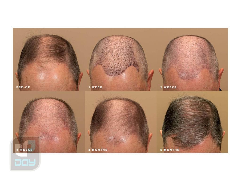 بررسی کامل انواع روش های کاشت مو، مراحل و مراقبتها 5 انواع روش های کاشت مو-4