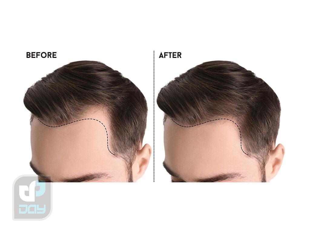 بررسی کامل انواع روش های کاشت مو، مراحل و مراقبتها 3 انواع روش های کاشت مو-2