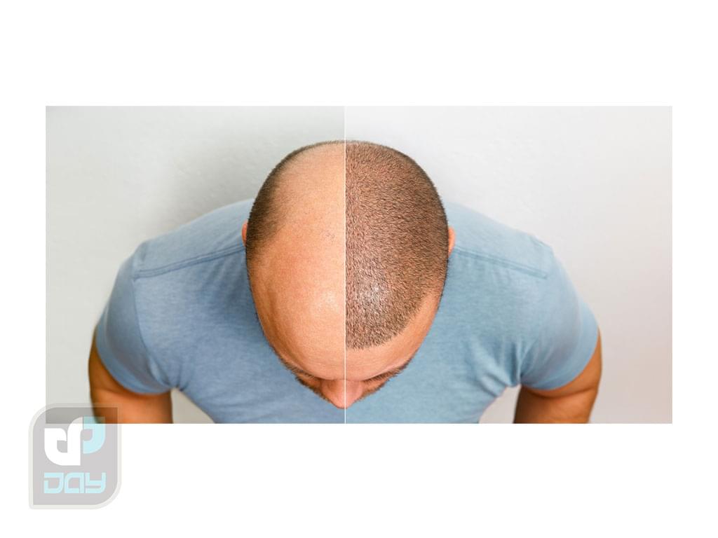 بررسی کامل انواع روش های کاشت مو، مراحل و مراقبتها 1 کاشت مو چیست