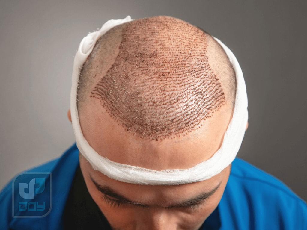 بررسی کامل انواع روش های کاشت مو، مراحل و مراقبتها 4 انواع روش های کاشت مو-3