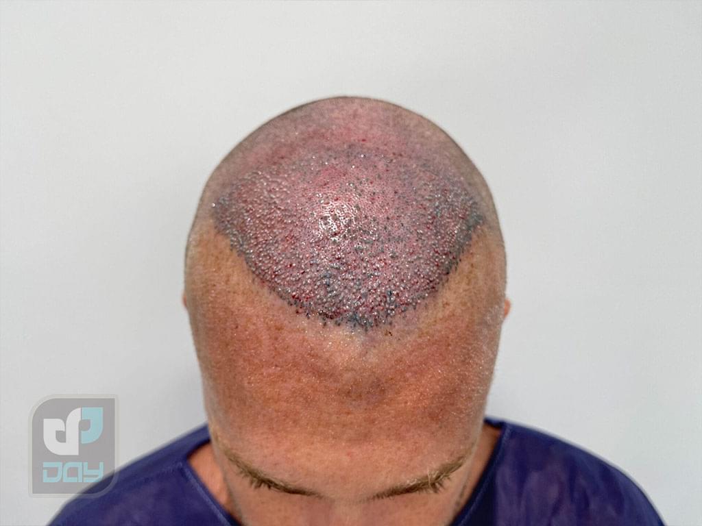 عوارض کاشت مو چیست؟ بررسی کامل عوارض پیوند مو در FUT و FUE 2 عوارض کاشت مو-2