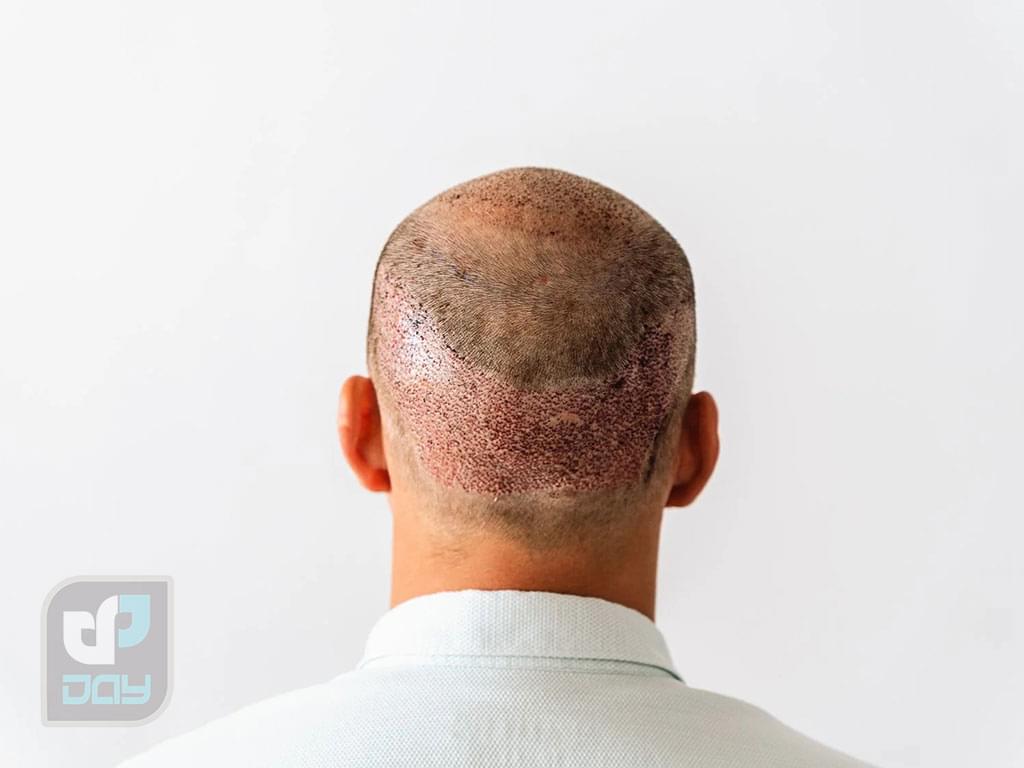 عوارض کاشت مو چیست؟ بررسی کامل عوارض پیوند مو در FUT و FUE 4 عوارض کاشت مو-4