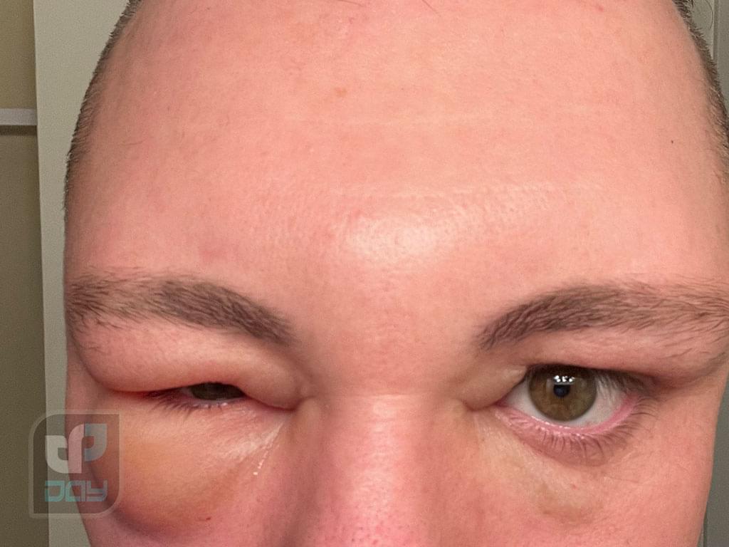 عوارض کاشت مو چیست؟ بررسی کامل عوارض پیوند مو در FUT و FUE 5 عوارض کاشت مو-6