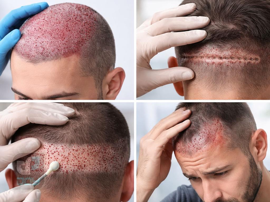 عوارض کاشت مو چیست؟ بررسی کامل عوارض پیوند مو در FUT و FUE 1 کاشت مو