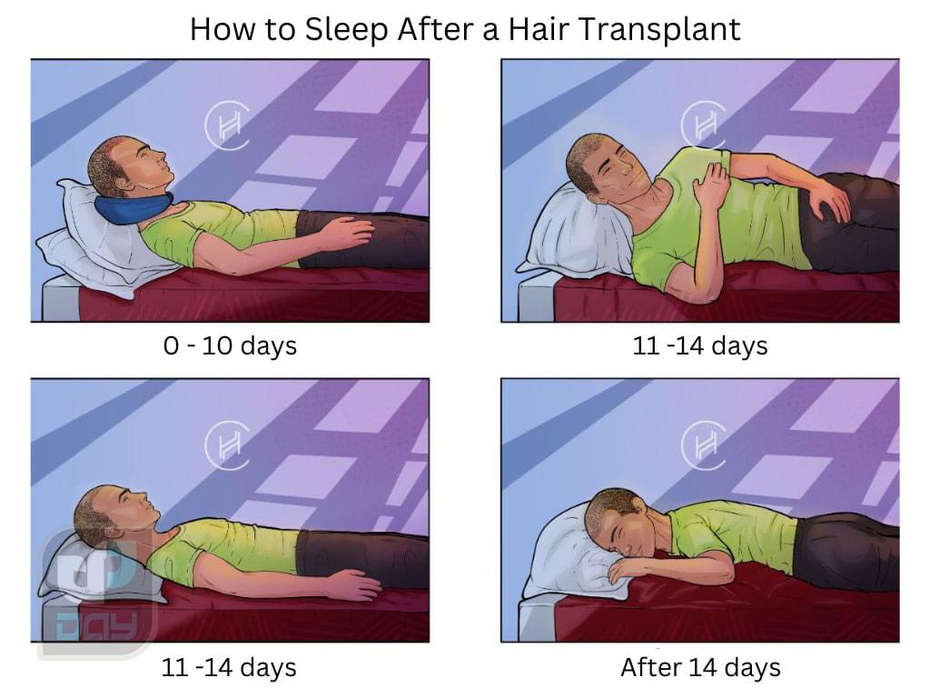 بهترین حالت خوابیدن بعد از کاشت مو؛ راهنمای شب اول و مراقبتهای خواب 3 نحوه صحیح خوابیدن بعد از کاشت مو-1