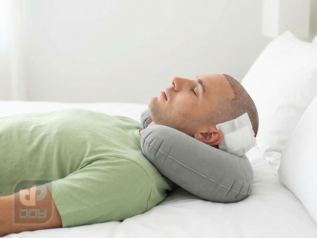 بهترین حالت خوابیدن بعد از کاشت مو؛ راهنمای شب اول و مراقبتهای خواب 4 نحوه صحیح خوابیدن بعد از کاشت مو-3