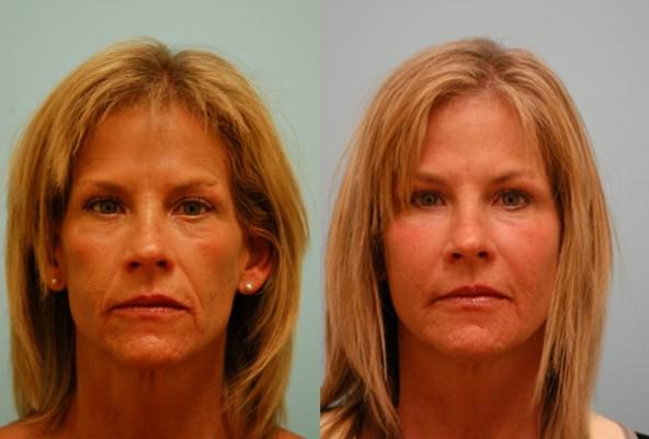 تزریق چربی به دست و صورت 1 1450863254