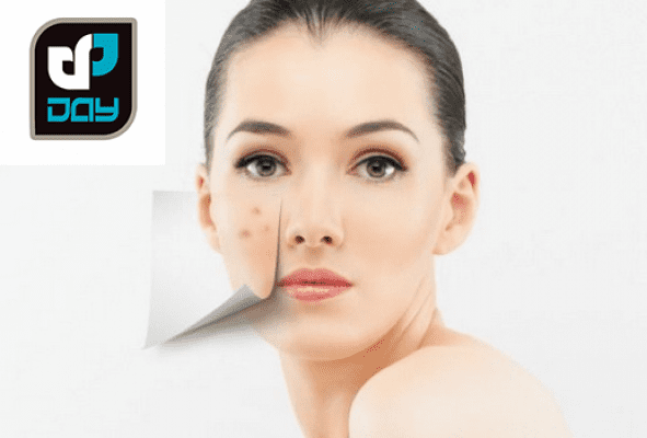 درمان لک کک و مک 1 درمان لک کک و مک