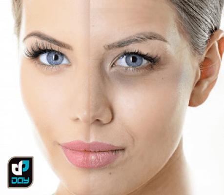 رفع سیاهی گودی و چروک دور چشم 1 رفع سیاهی گودی و چروک دور چشم
