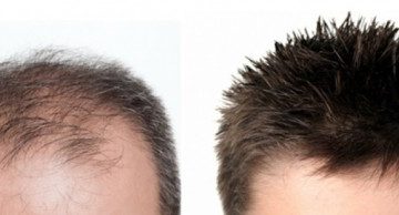 کاشت مو در کرمان