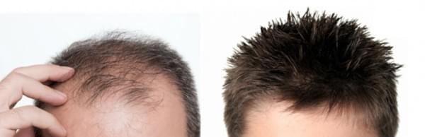 کاشت مو در کرمان 1 کاشت مو در کرمان