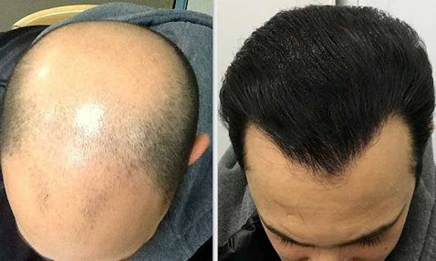 بهترین دکتر و کلینیک کاشت مو در شیراز