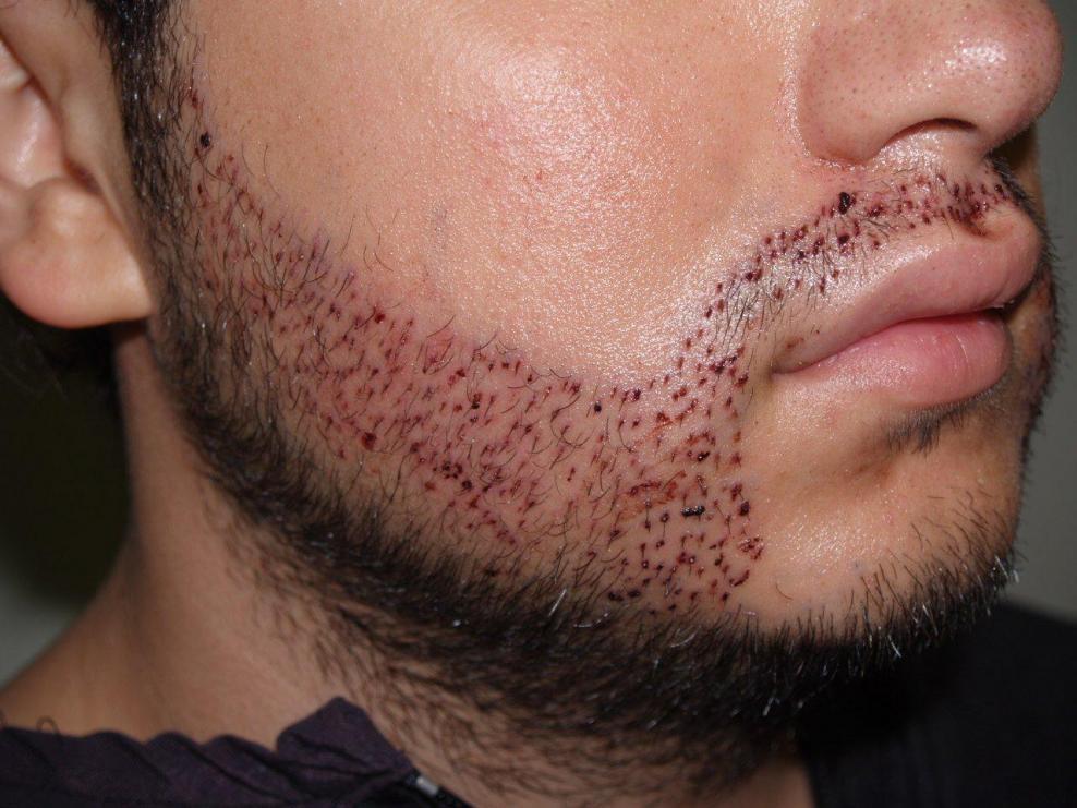 هر آنچه در مورد کاشت ریش باید بدانید 4 کاشت ریش