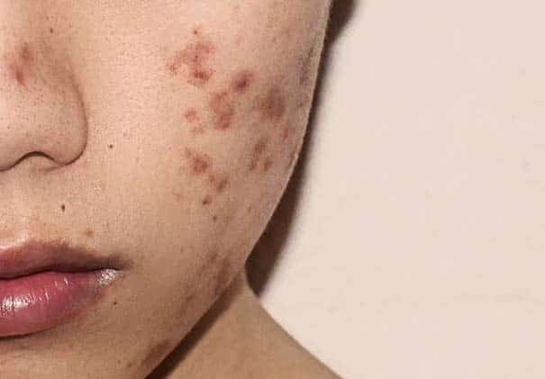 علل ایجاد هایپرپیگمنتیشن