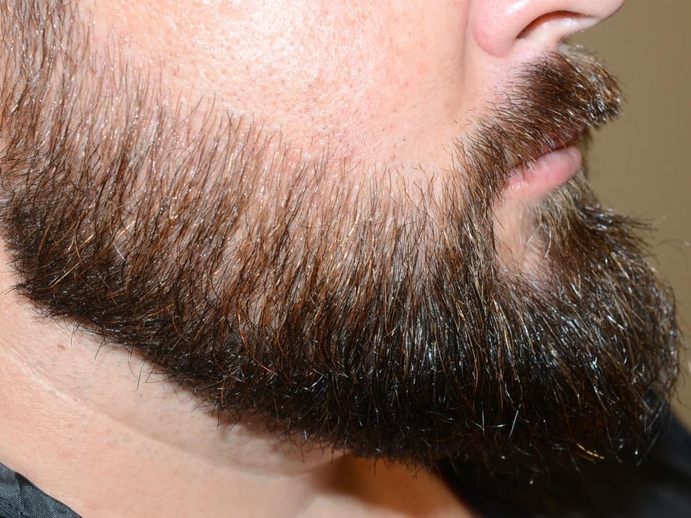 هر آنچه در مورد کاشت ریش باید بدانید 2 کاشت ریش