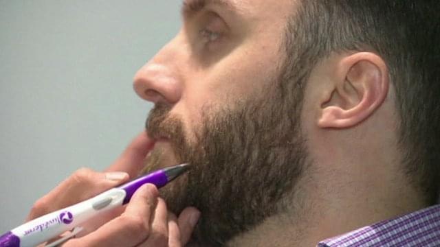 هر آنچه در مورد کاشت ریش باید بدانید 3 کاشت ریش