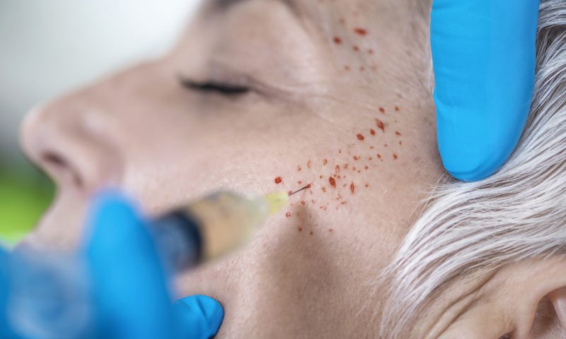 جوانسازی پوست صورت با PRP و مزایای آن 1 Prp2
