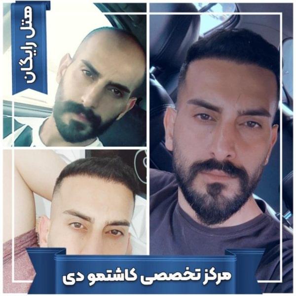 کاشت مو 36 1699167878 600x600