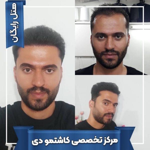 کاشت مو 35 1699167897 600x600