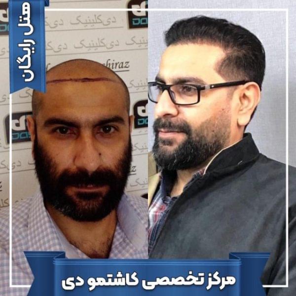 کاشت مو 24 1699167905 600x600