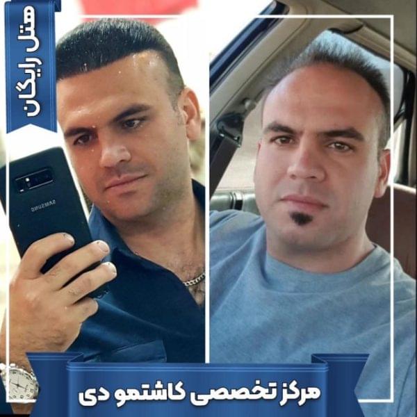 کاشت مو 23 1699167928 600x600