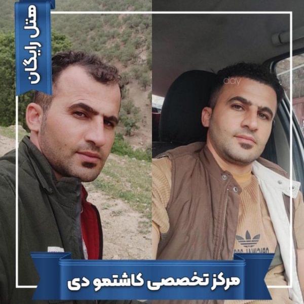 کاشت مو 38 1699167935 600x600