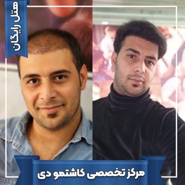 کاشت مو 37 1699167941 600x600