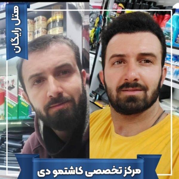 کاشت مو 22 1699167949 600x600