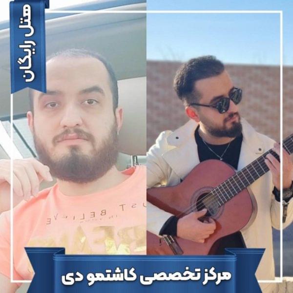 کاشت مو 26 1699167956 600x600