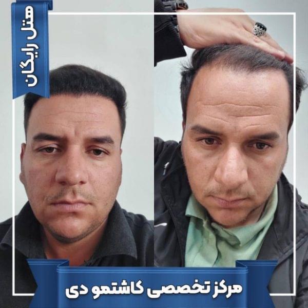 کاشت مو 27 1699167965 600x600