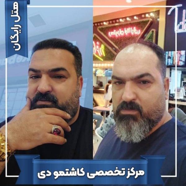 کاشت مو 21 1699167988 600x600