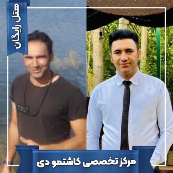 کاشت مو 20 1699168064 600x600