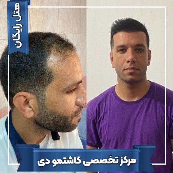 کاشت مو 25 1699168088 600x600